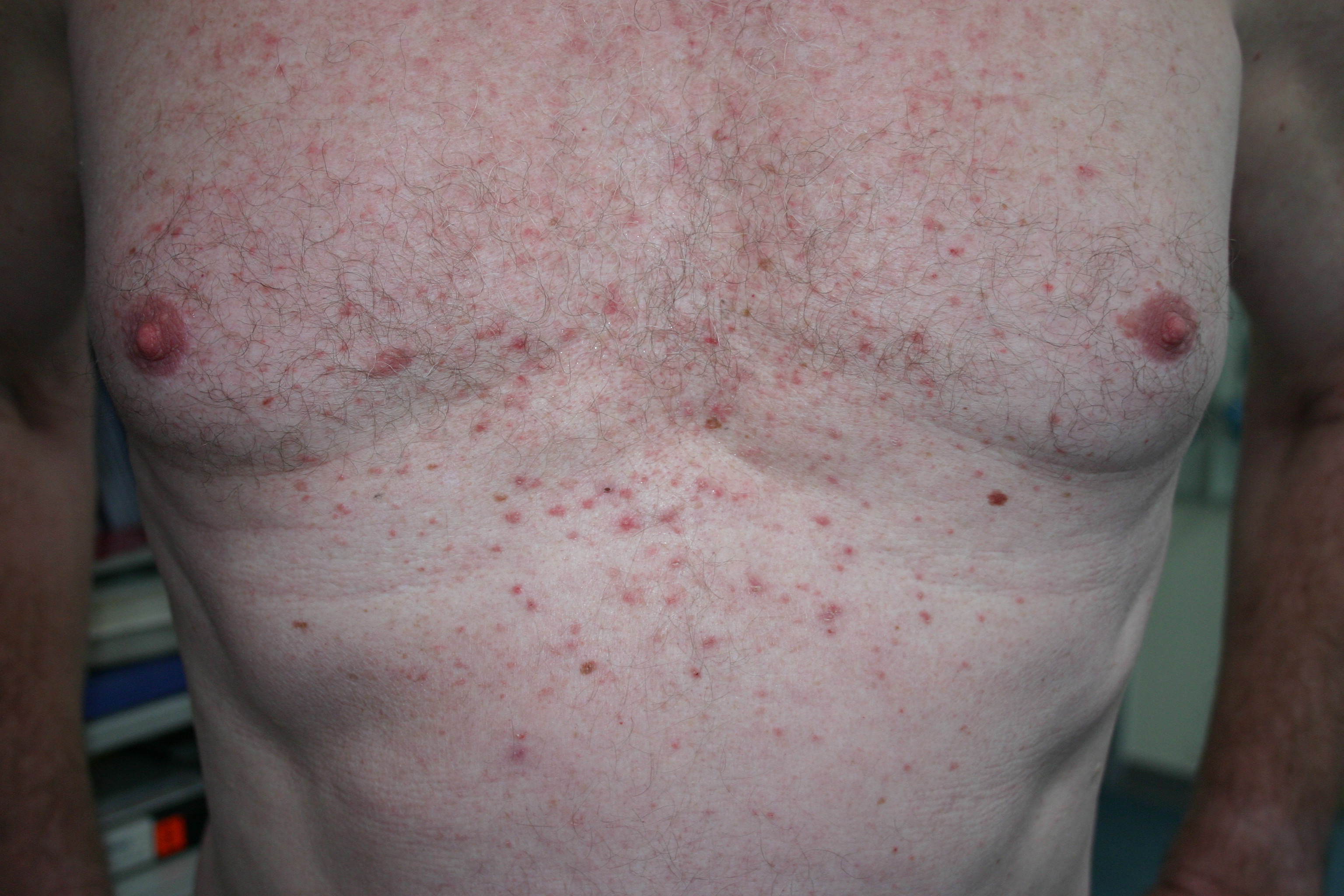 Morbus Grover (transient acantholytic dermatosis)