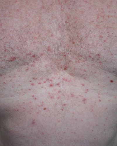 Morbus Grover (transient acantholytic dermatosis)