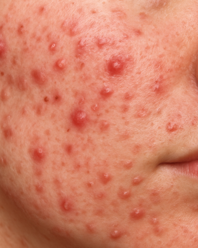 Acne: niet hetzelfde als jeugdpuistjes