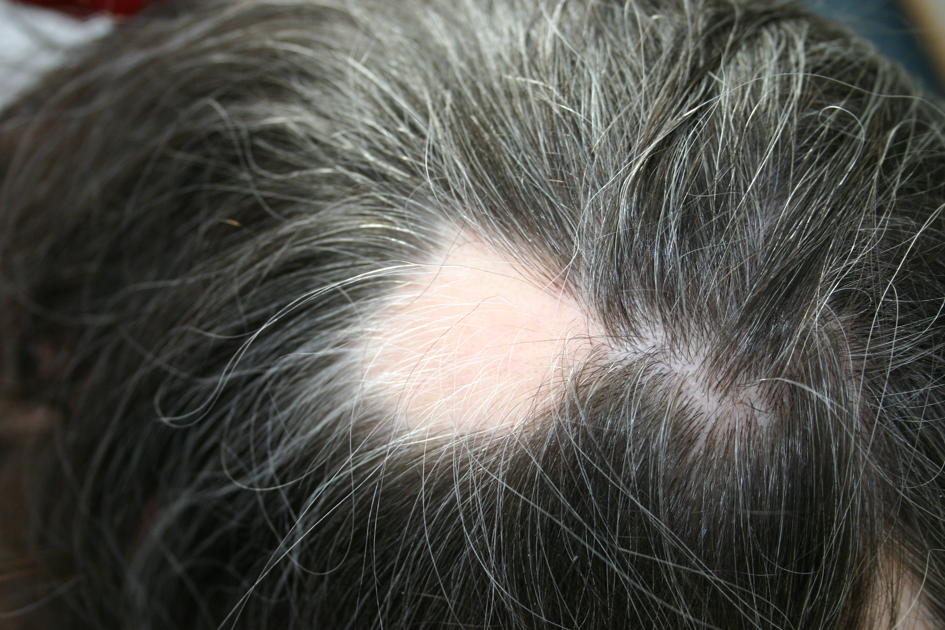 Alopecia areata