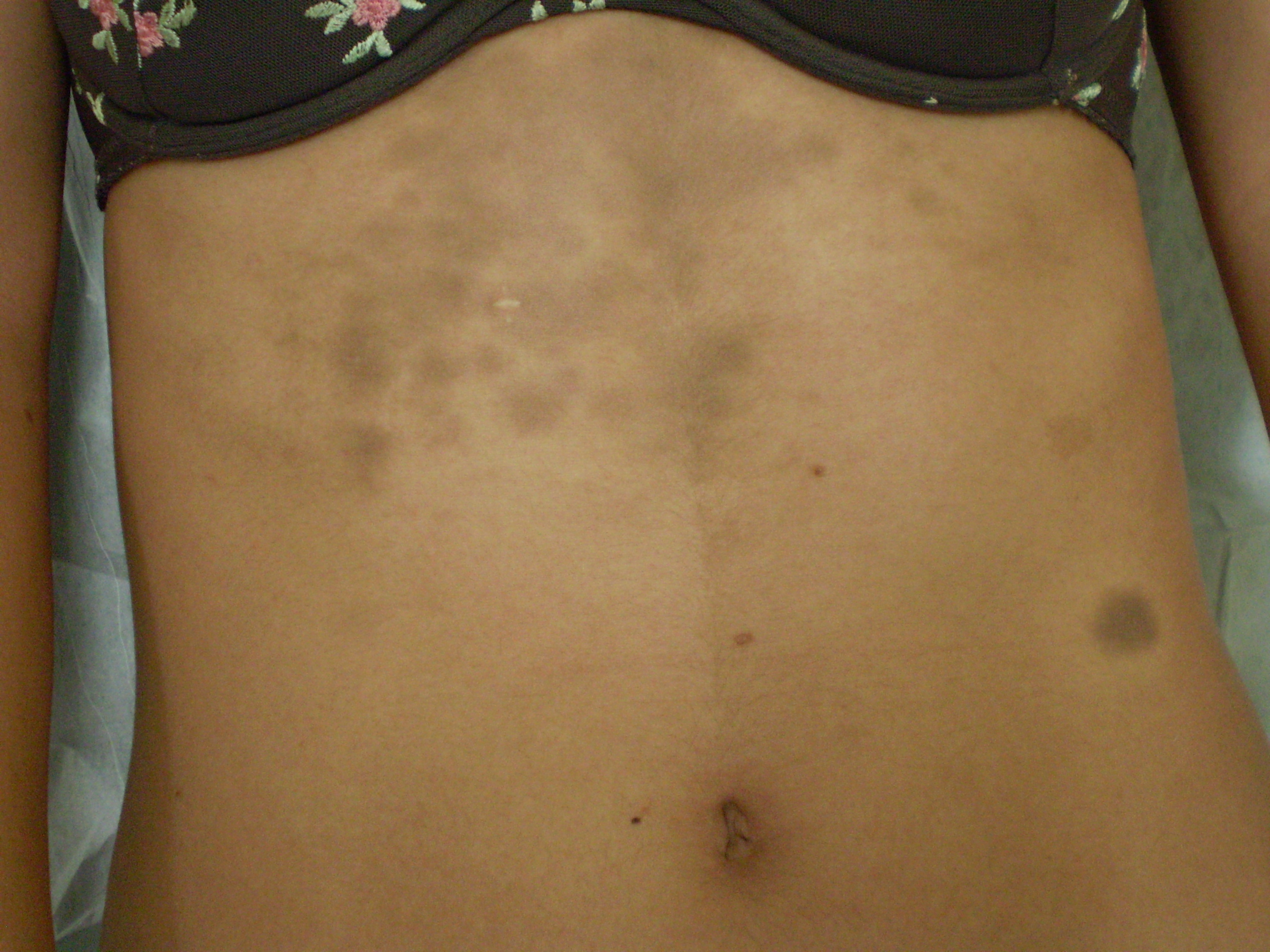 Ashy Dermatosis (aanhoudende erythema dyschromicum)