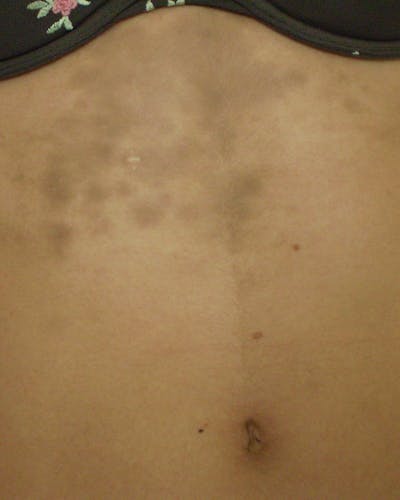 Ashy Dermatosis (aanhoudende erythema dyschromicum)