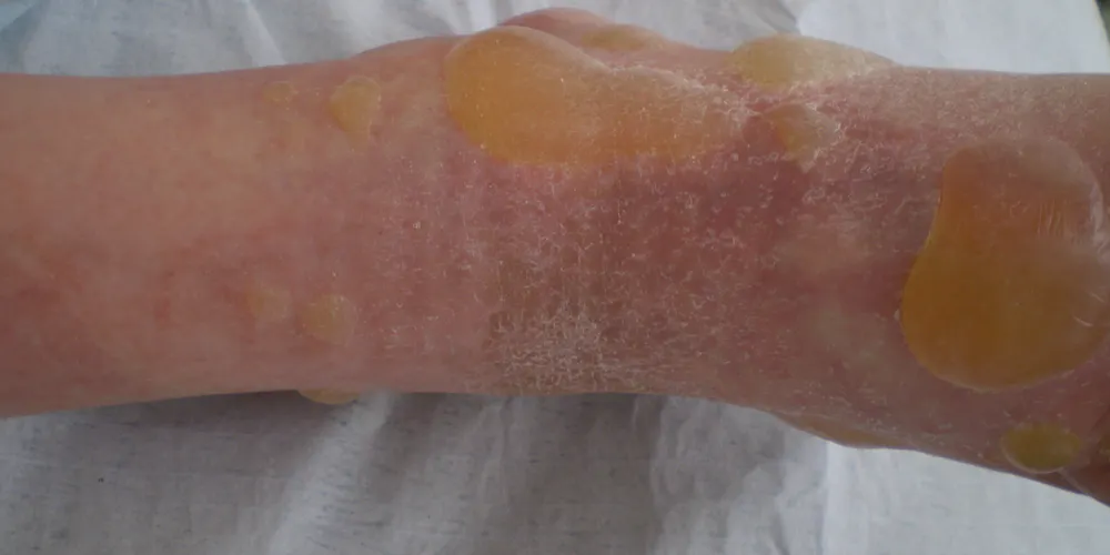 Bulleus Pemphigoid