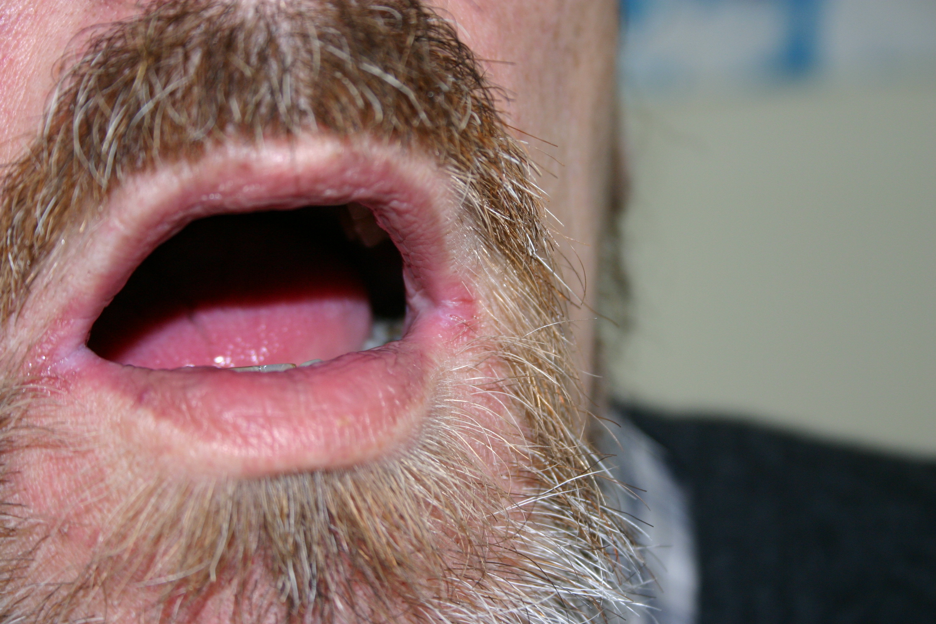 Perlèche (Cheilitis Angularis)