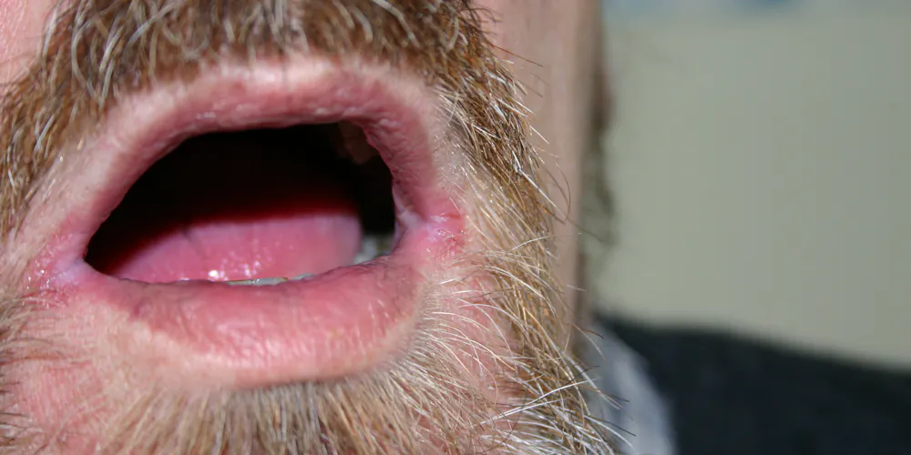 Perlèche (Cheilitis Angularis)
