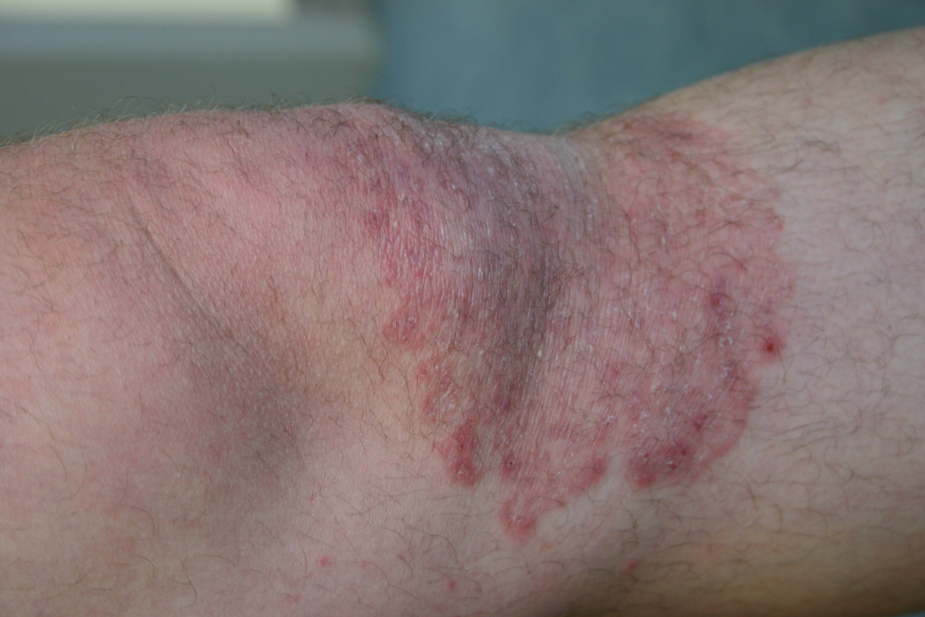 Schimmelinfectie van de huid (mycose, tinea, schimmel)