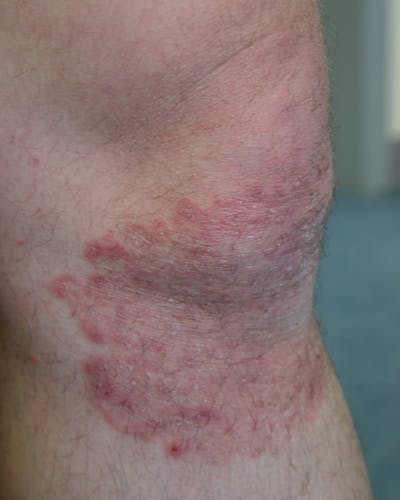 Schimmelinfectie van de huid (mycose, tinea, schimmel)