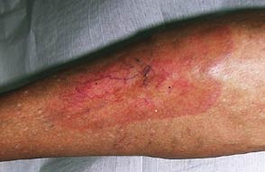 Necrobiosis Lipoidica