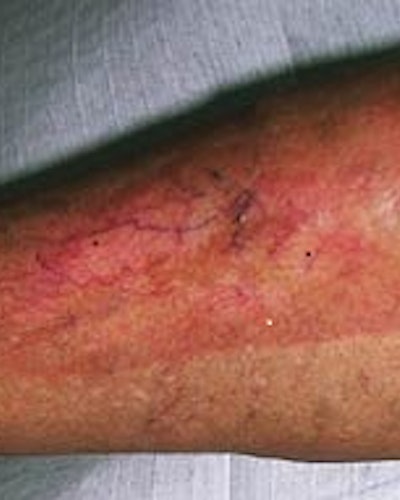 Necrobiosis Lipoidica