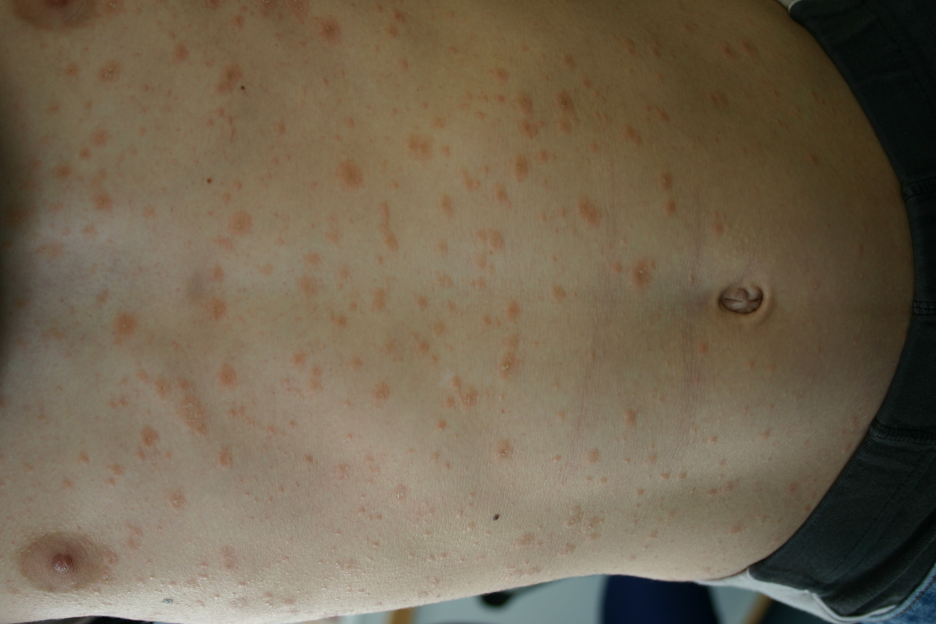 Pityriasis Rosea