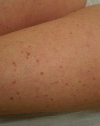 Urticaria Pigmentosa