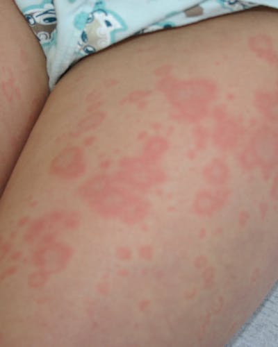 Urticaria