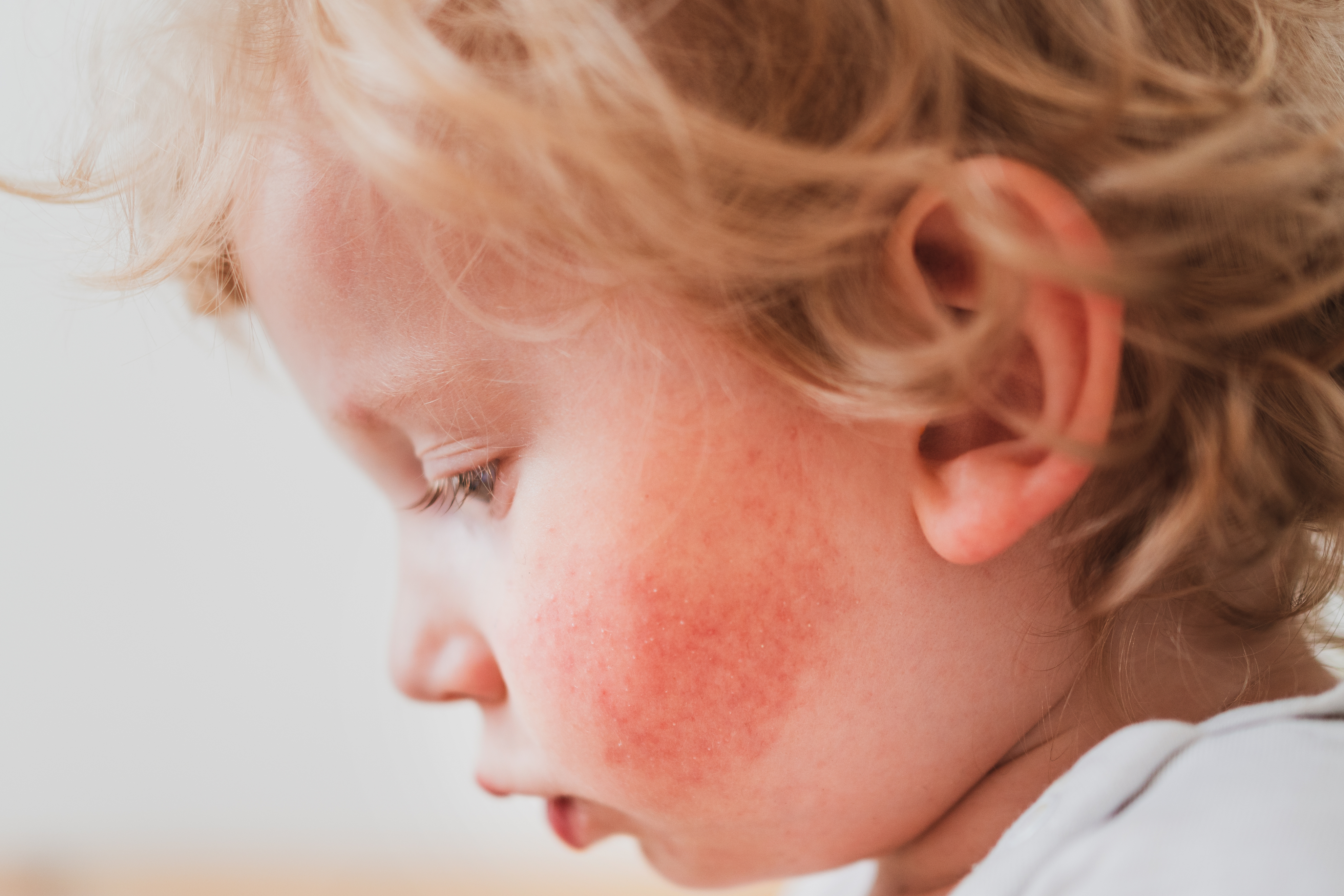 A skin complaint on your child