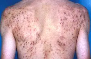acne4