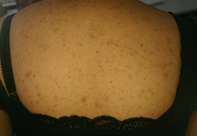 Pityrosporon folliculitis