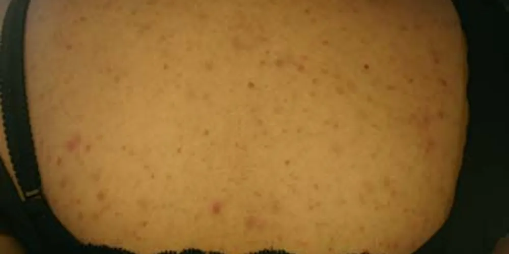 Pityrosporon-Follikulitis
