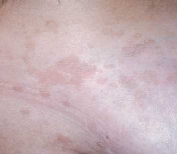 Pityriasis Versicolor