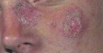 Chronisch Discoïde Lupus Erythematodes (CDLE)