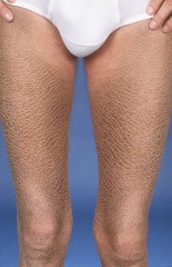 Ichthyosis