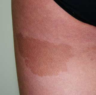 Café-au-lait-vlekken