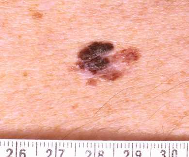 Lentigo maligna melanoma
