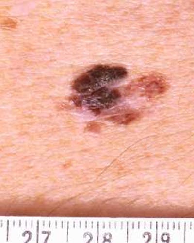 Melanoma Lentigo Maligna