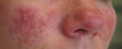 Rosacea
