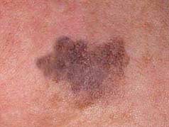 Lentigo Maligna (ziekte van Dubreuilh)