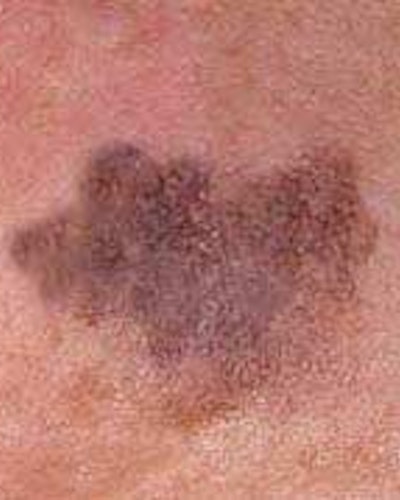 Lentigo Maligna (ziekte van Dubreuilh)