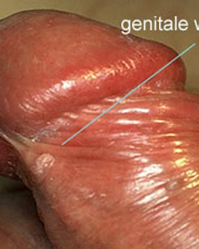 Condylomata Acuminata (Verrugas Genitales)