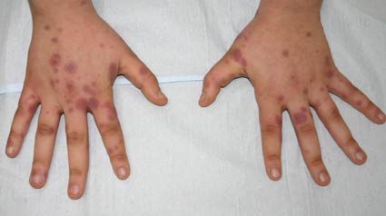 Erythema Exsudativum Multiforme