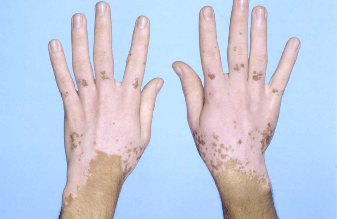 Vitiligo