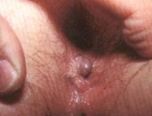 Peri-anaal Trombose