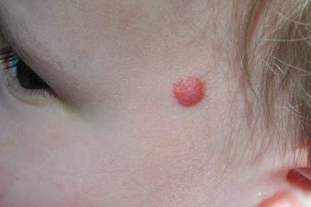 Xantogranuloma Juvenil