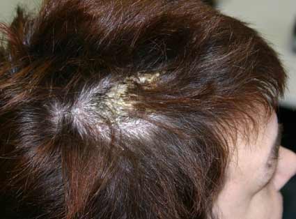 Pityriasis amiantacea