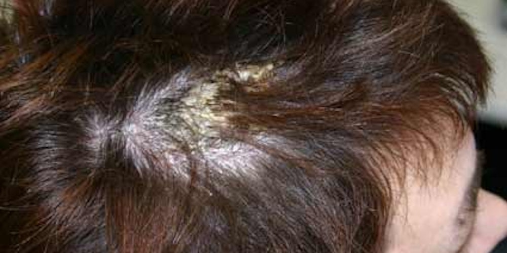 Pityriasis amiantacea