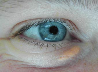 Xanthelasma