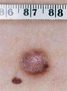 Histiocytoom (Dermatofibroom)