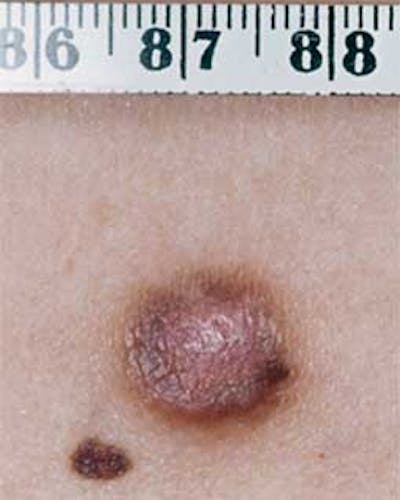 Histozytom (Dermatofibrom)