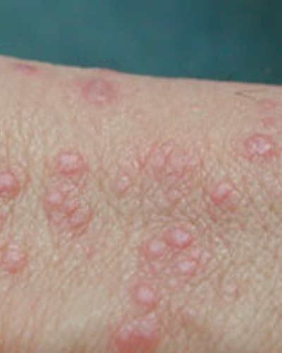 Lichen planus