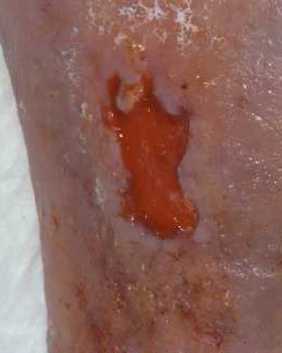 Úlcera venosa en la pierna