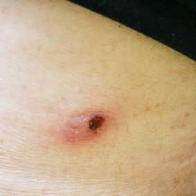 Lymfomatoïde papulose