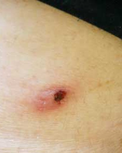 Lymfomatoïde papulose