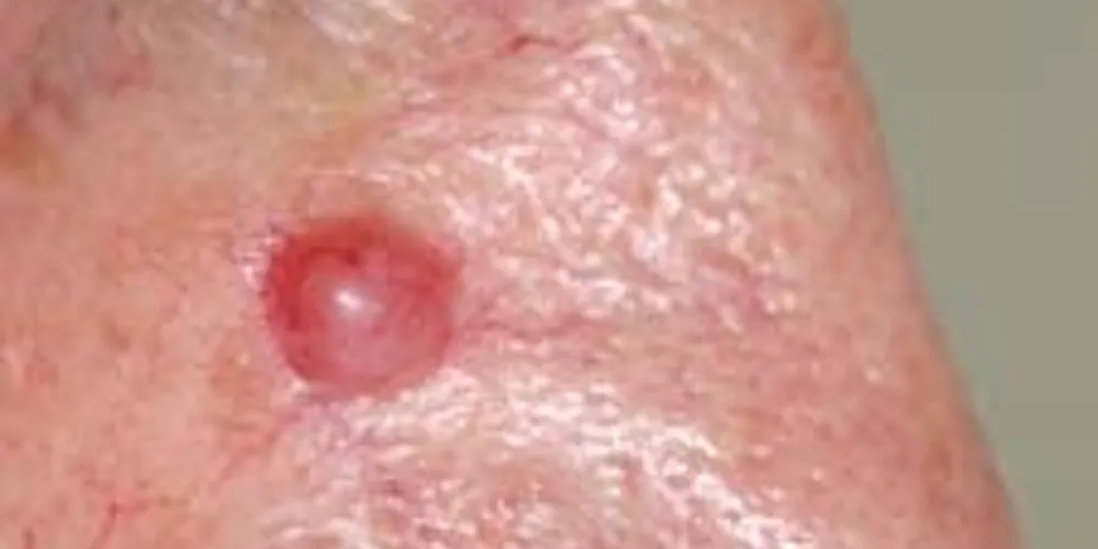 Carcinoma Basocelular