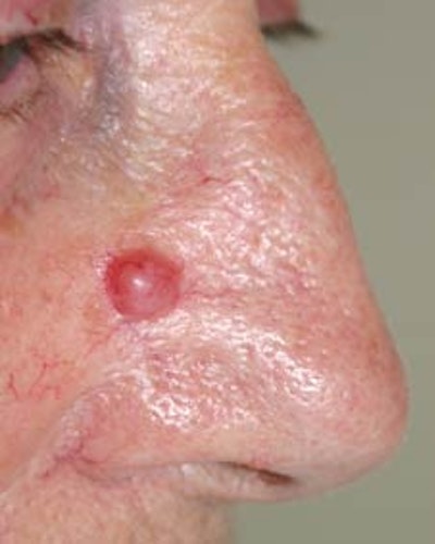 Carcinoma Basocelular