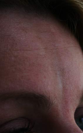 Esclerodermia localizada