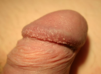 Pearly Penile Papules