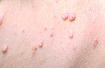 Molusco contagioso