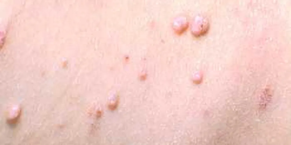 Molusco contagioso