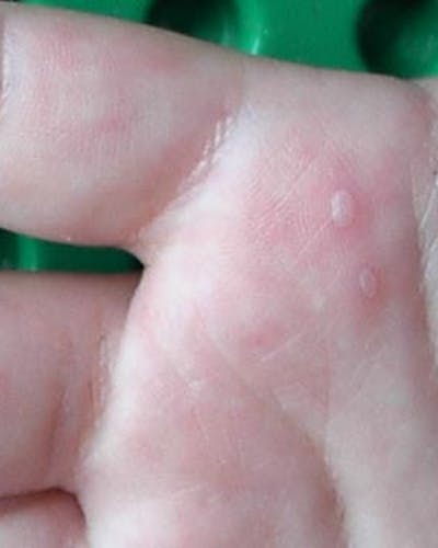 Enfermedad mano-pie-boca